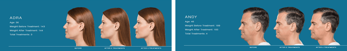 kybella-before-after