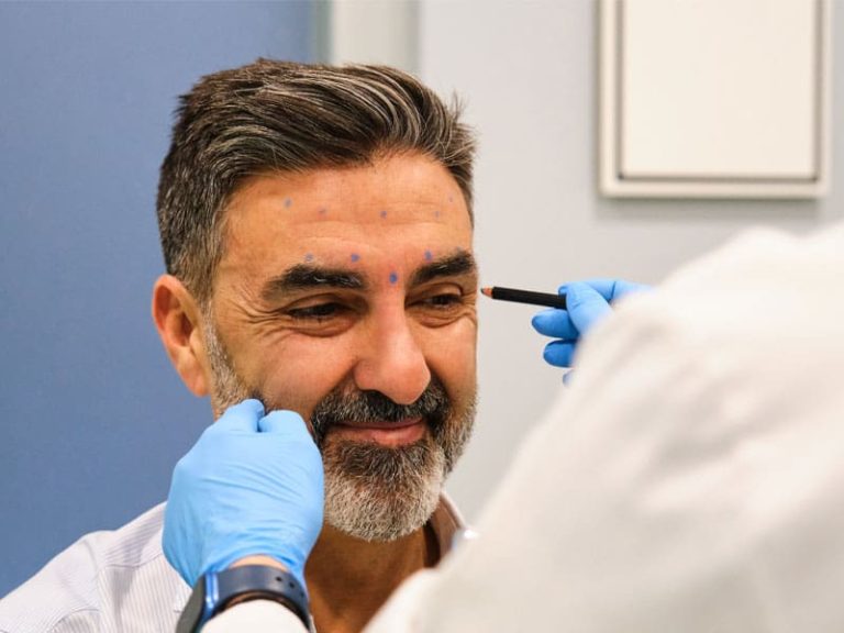 man having placement marks for Botox treatment to illustrate how long does Botox last