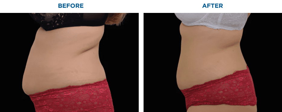 EMSCULPT NEO TREATMENT1 MONTH AFTER THE LAST TREATMENT, COURTESY OF BTL AESTHETICSPatient results and experiences may vary.