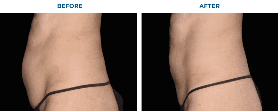 EMSCULPT NEO TREATMENT3 MONTHS AFTER THE LAST TREATMENT, COURTESY OF BRUCE KATZ, M.D.Patient results and experiences may vary.