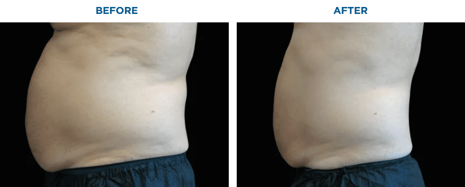 EMSCULPT NEO TREATMENT1 MONTH AFTER THE LAST TREATMENT, COURTESY OF DAVID KENT, M.D.Patient results and experiences may vary.