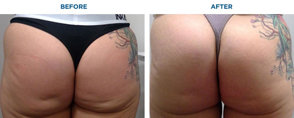 EMSCULPT NEO TREATMENT1 MONTH AFTER THE LAST TREATMENT, COURTESY OF BTL AESTHETICSPatient results and experiences may vary.