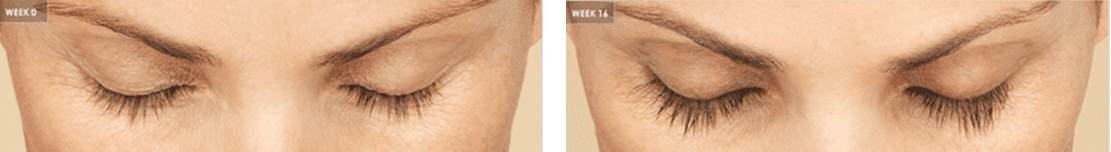 latisse-before-after