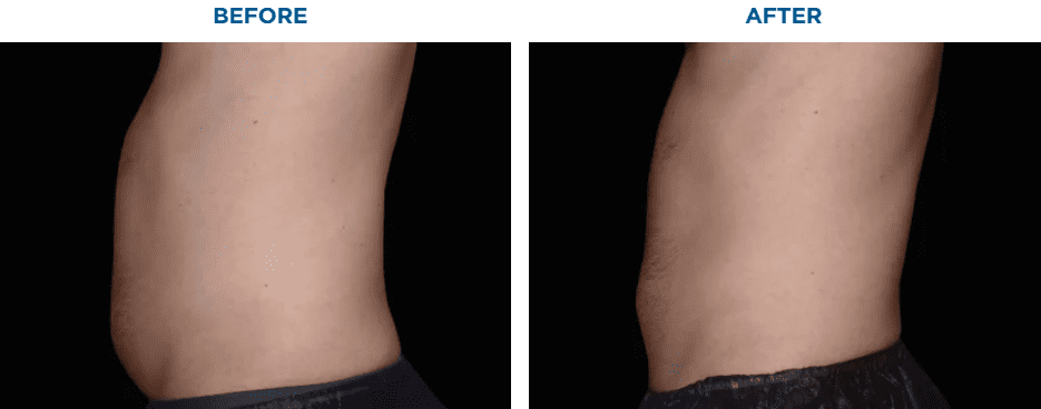 EMSCULPT NEO TREATMENT3 MONTHS AFTER THE LAST TREATMENT, COURTESY OF CAROLYN JACOB, M.D.Patient results and experiences may vary.