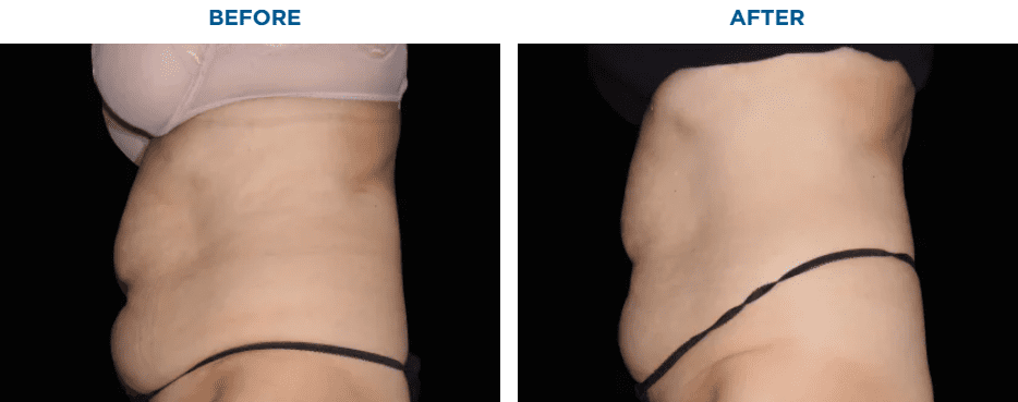 EMSCULPT NEO TREATMENT3 MONTHS AFTER THE LAST TREATMENT, COURTESY OF BRUCE E. KATZ, M.D.Patient results and experiences may vary.