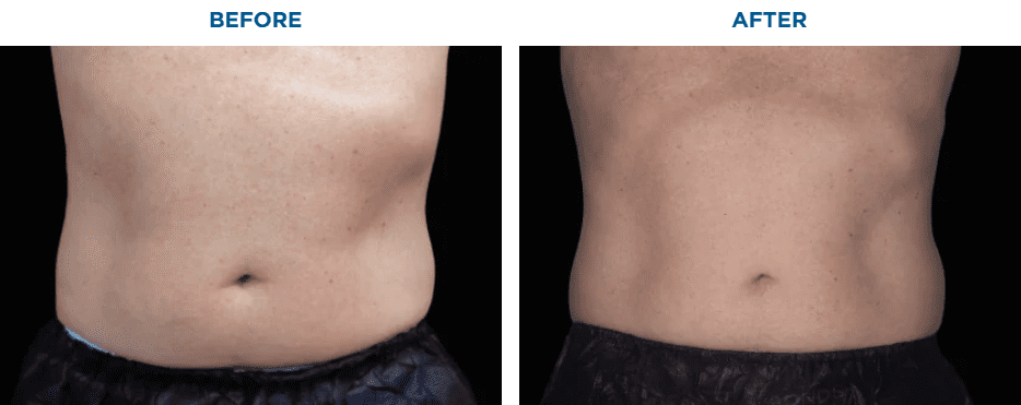 EMSCULPT NEO TREATMENT6 MONTHS AFTER THE LAST TREATMENT, COURTESY OF DAVID KENT, M.D.Patient results and experiences may vary.