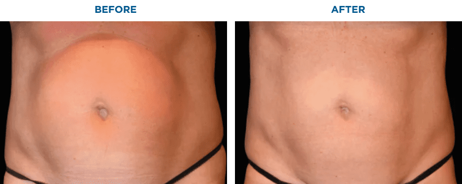 EMSCULPT NEO TREATMENT6 MONTHS AFTER THE LAST TREATMENT, COURTESY OF JULENE SAMUELS, M.D.Patient results and experiences may vary.