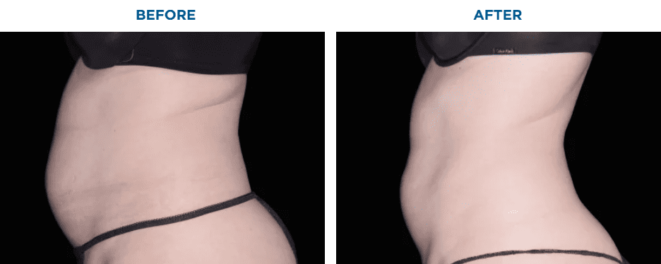 EMSCULPT NEO TREATMENT6 MONTHS AFTER THE LAST TREATMENT, COURTESY OF BRUCE E. KATZ, M.D.Patient results and experiences may vary.