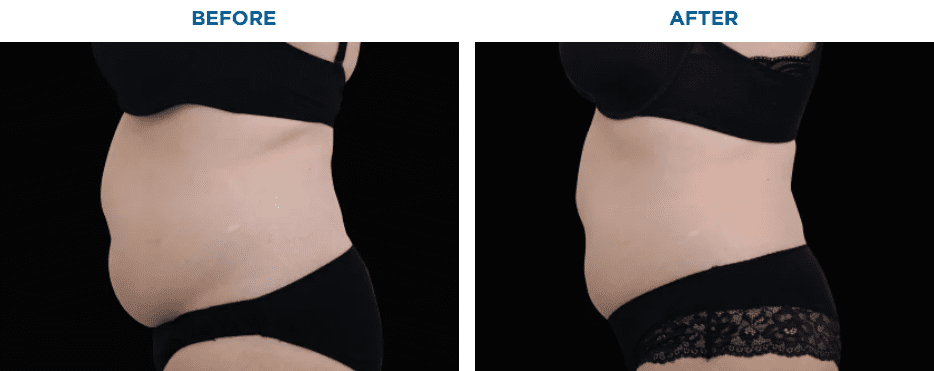 EMSCULPT NEO TREATMENT1 MONTH AFTER THE LAST TREATMENT, COURTESY OF DAVID KENT, M.D.Patient results and experiences may vary.