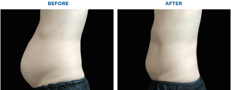 EMSCULPT NEO TREATMENT1 MONTH AFTER THE LAST TREATMENT, COURTESY OF DAVID KENT, M.D.Patient results and experiences may vary.