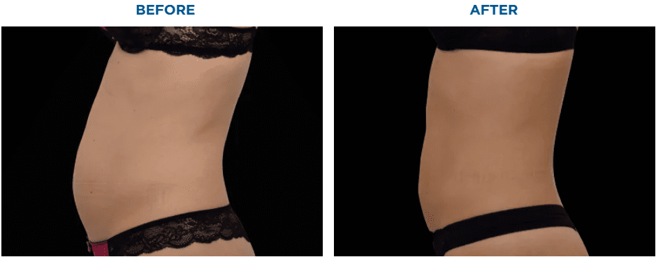 EMSCULPT NEO TREATMENT1 MONTH AFTER THE LAST TREATMENT, COURTESY OF BRUCE E. KATZ, M.D.Patient results and experiences may vary.