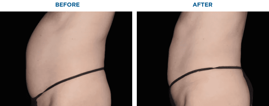 EMSCULPT NEO TREATMENT1 MONTH AFTER THE LAST TREATMENT, COURTESY OF BRUCE E. KATZ, M.D.Patient results and experiences may vary.