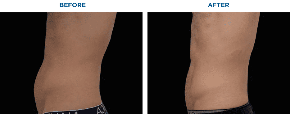 EMSCULPT NEO TREATMENT1 MONTH AFTER THE LAST TREATMENT, COURTESY OF DAVID KENT, M.D.Patient results and experiences may vary.