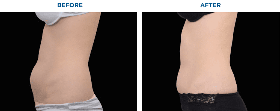 EMSCULPT NEO TREATMENT3 MONTHS AFTER THE LAST TREATMENT, COURTESY OF BRUCE E. KATZ, M.D.Patient results and experiences may vary.