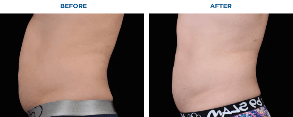 EMSCULPT NEO TREATMENT1 MONTH AFTER THE LAST TREATMENT, COURTESY OF DAVID KENT, M.D.Patient results and experiences may vary.