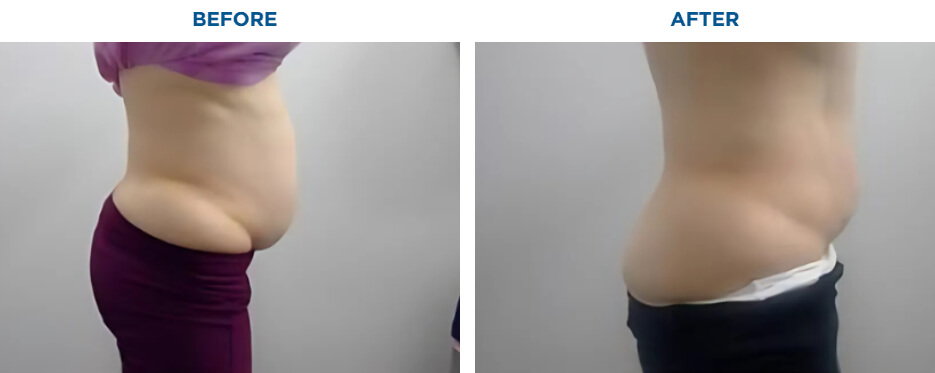 EMSCULPT NEO TREATMENTKAREN J -ACTUAL PATIENT, 4 EMSCULPT NEO SESSIONS.Patient results and experiences may vary.