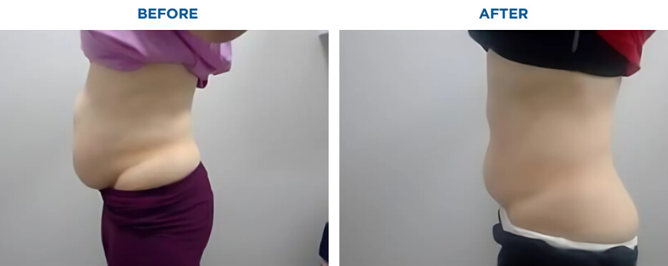 EMSCULPT NEO TREATMENTKAREN J -ACTUAL PATIENT, 4 EMSCULPT NEO SESSIONS.Patient results and experiences may vary.