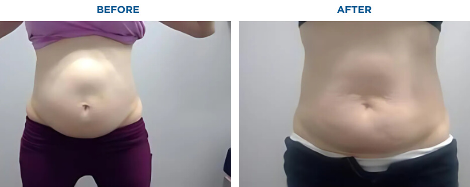 EMSCULPT NEO TREATMENTKAREN J -ACTUAL PATIENT, 4 EMSCULPT NEO SESSIONS.Patient results and experiences may vary.