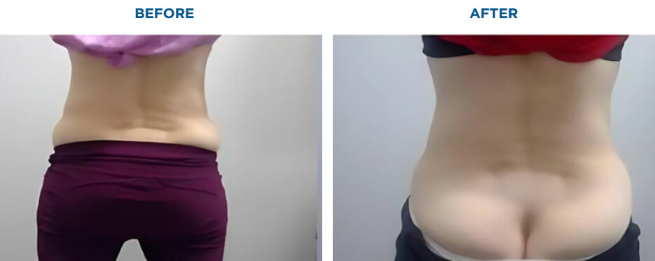 EMSCULPT NEO TREATMENTKAREN J -ACTUAL PATIENT, 4 EMSCULPT NEO SESSIONS.Patient results and experiences may vary.