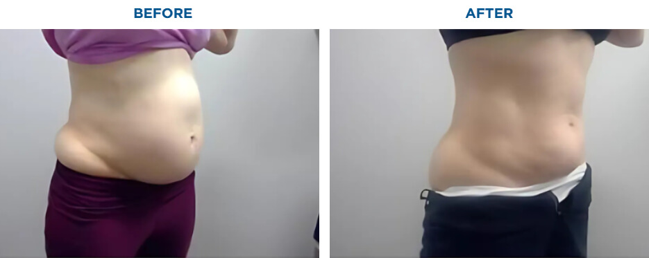 EMSCULPT NEO TREATMENTKAREN J -ACTUAL PATIENT, 4 EMSCULPT NEO SESSIONS.Patient results and experiences may vary.