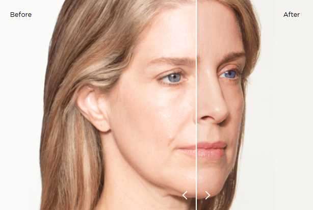 sculptra results 10