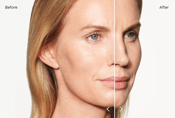 sculptra results 12