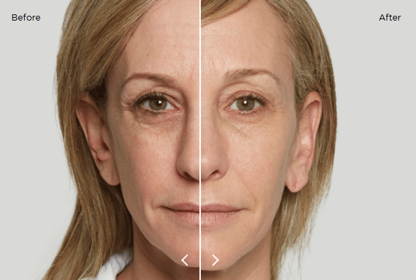 sculptra results 13