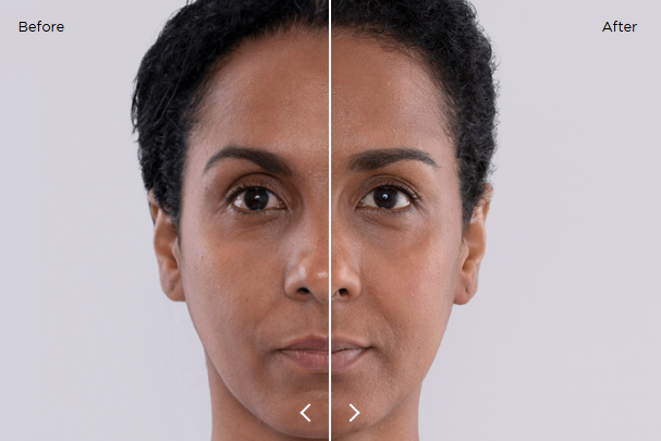 sculptra results 14