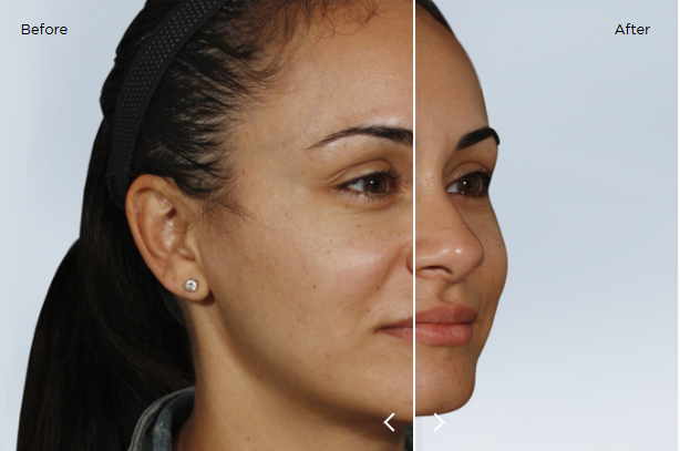 sculptra results 5