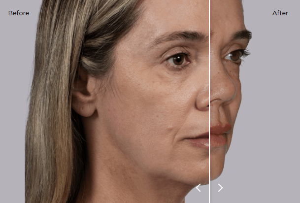 sculptra results 7
