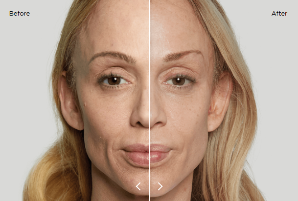 sculptra results 8